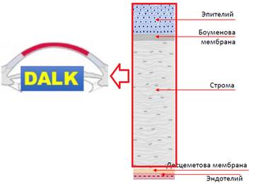 Глубокая передняя послойная кератопластика (ГППК), DeepAnteriorLamellarKeratoplasty (DALK)