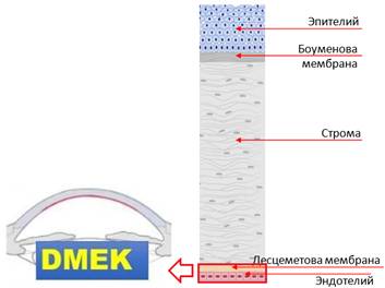 Эндотелиальная кератопластика десцеметовой оболочки. DMEK (Descemet Membrane Endothelial Keratoplasty) 