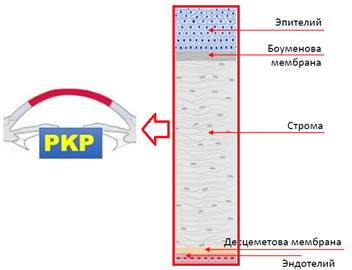 Сквозная (проникающая) кератопластика (СКП), PenetratingKeratoplasty (PKP)