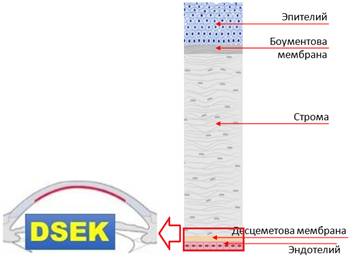 Задняя (автоматизированная)эндотелиальная кератопластика с удалением десцеметовой мембраны,DSAEK/DSEK (Descemet-stripping(Automated)EndothelialKeratoplasty)